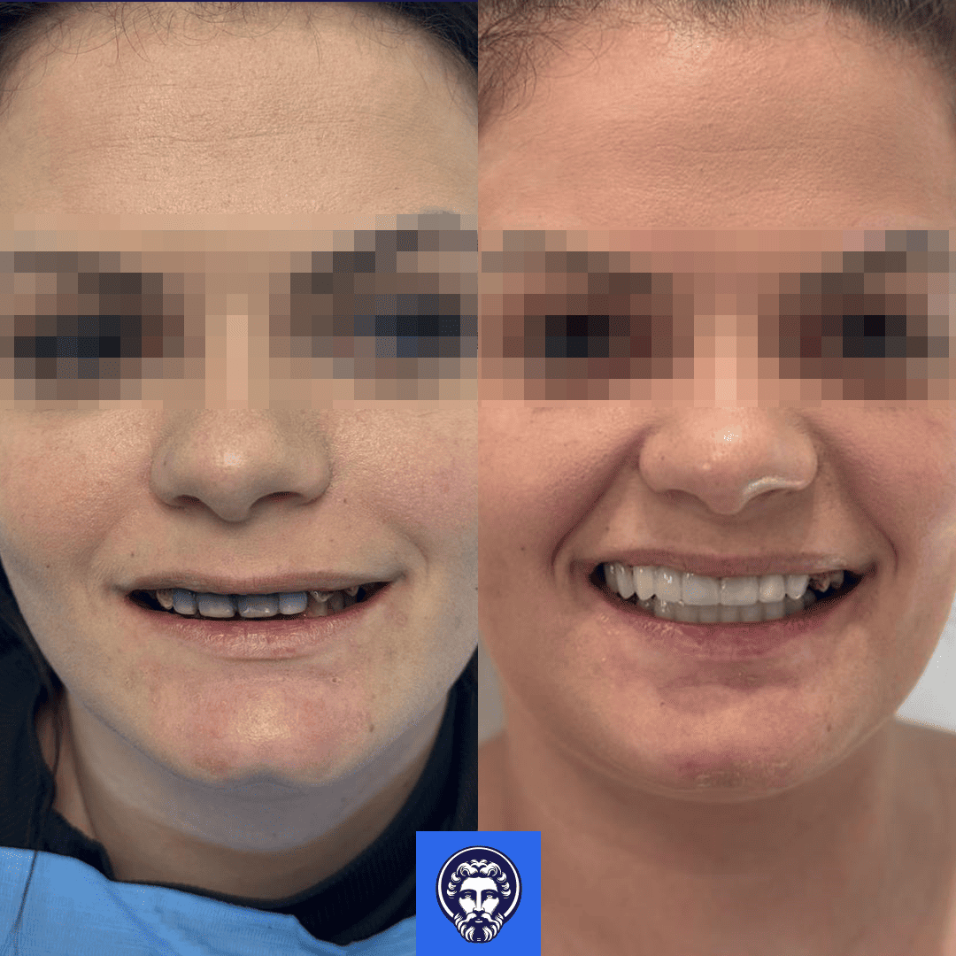 alexandra before_after
