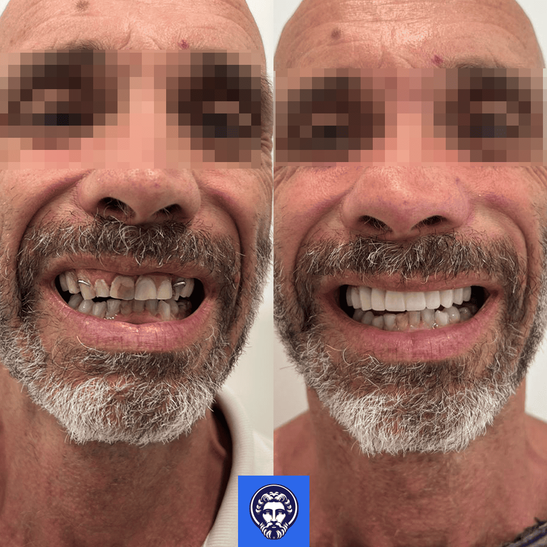 andrea palazzo before_after