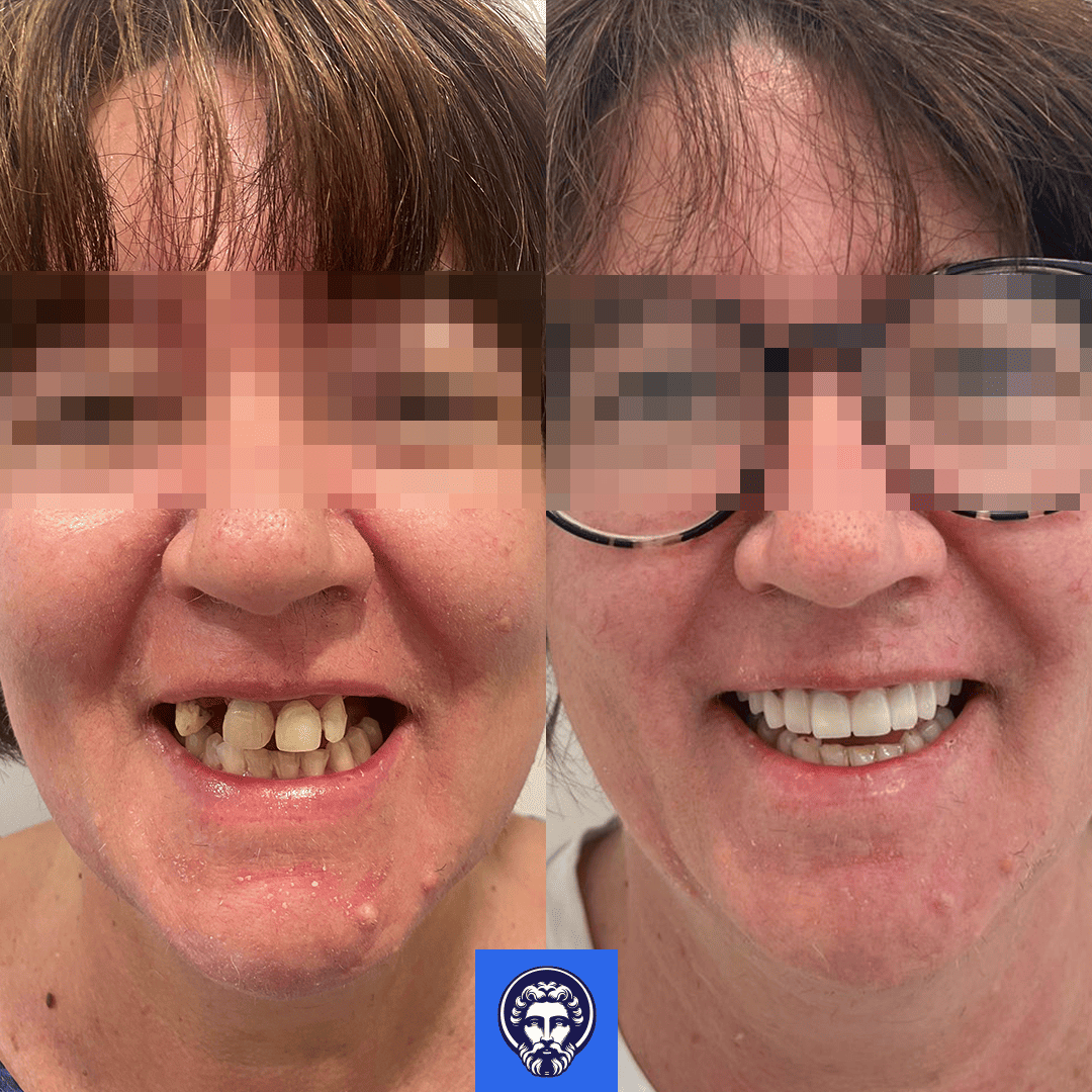 anna lisa solina before_after