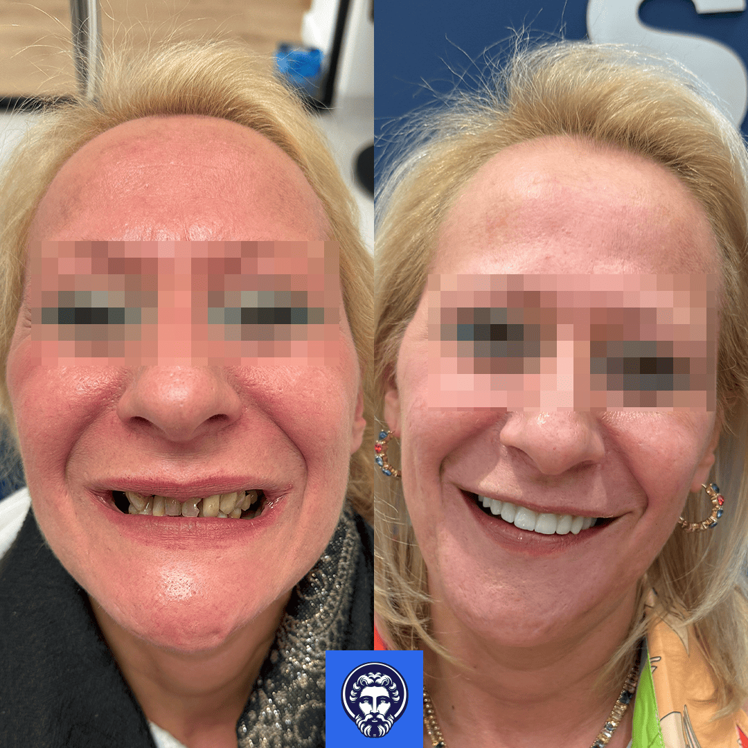 antonella before_after