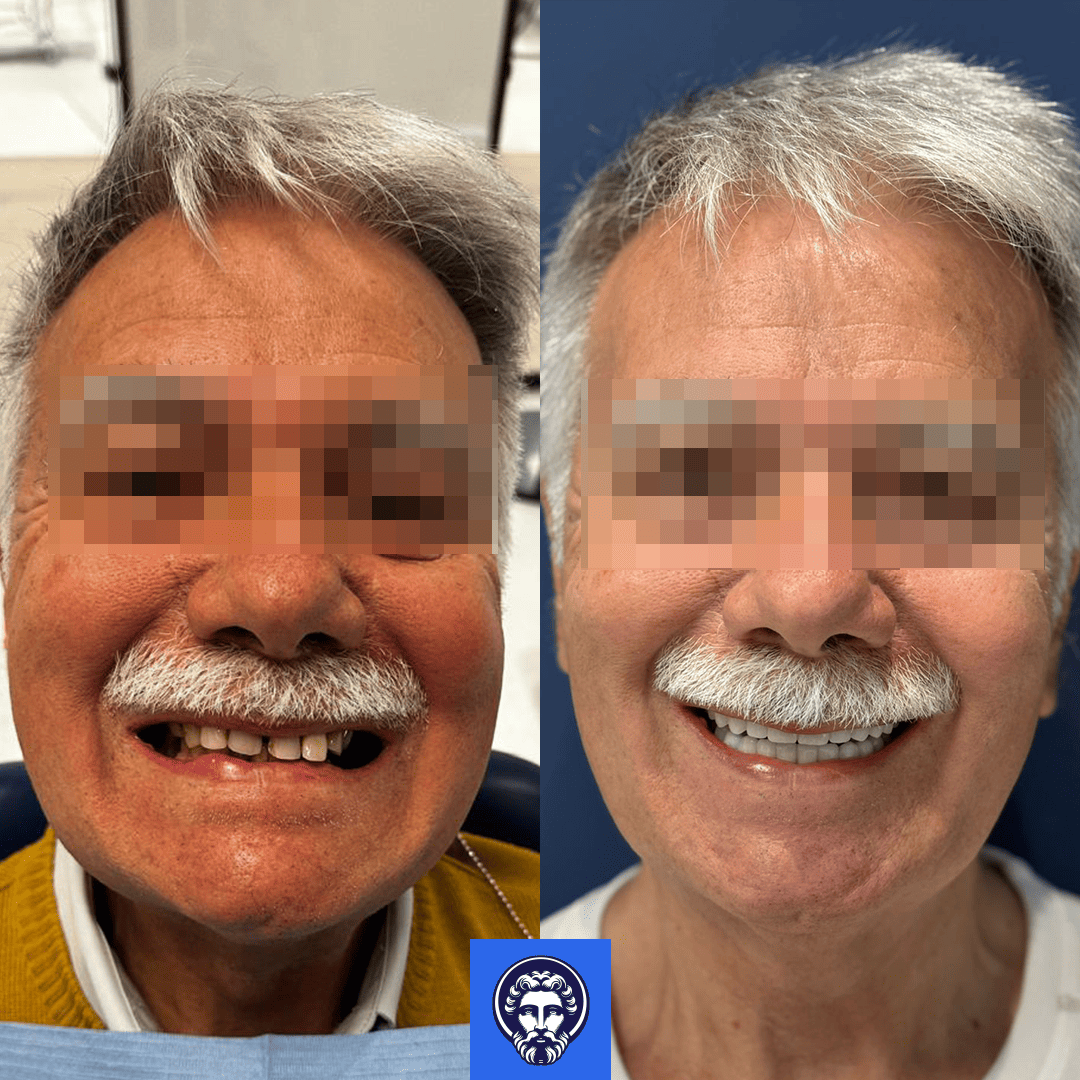 antonio limonta before_after