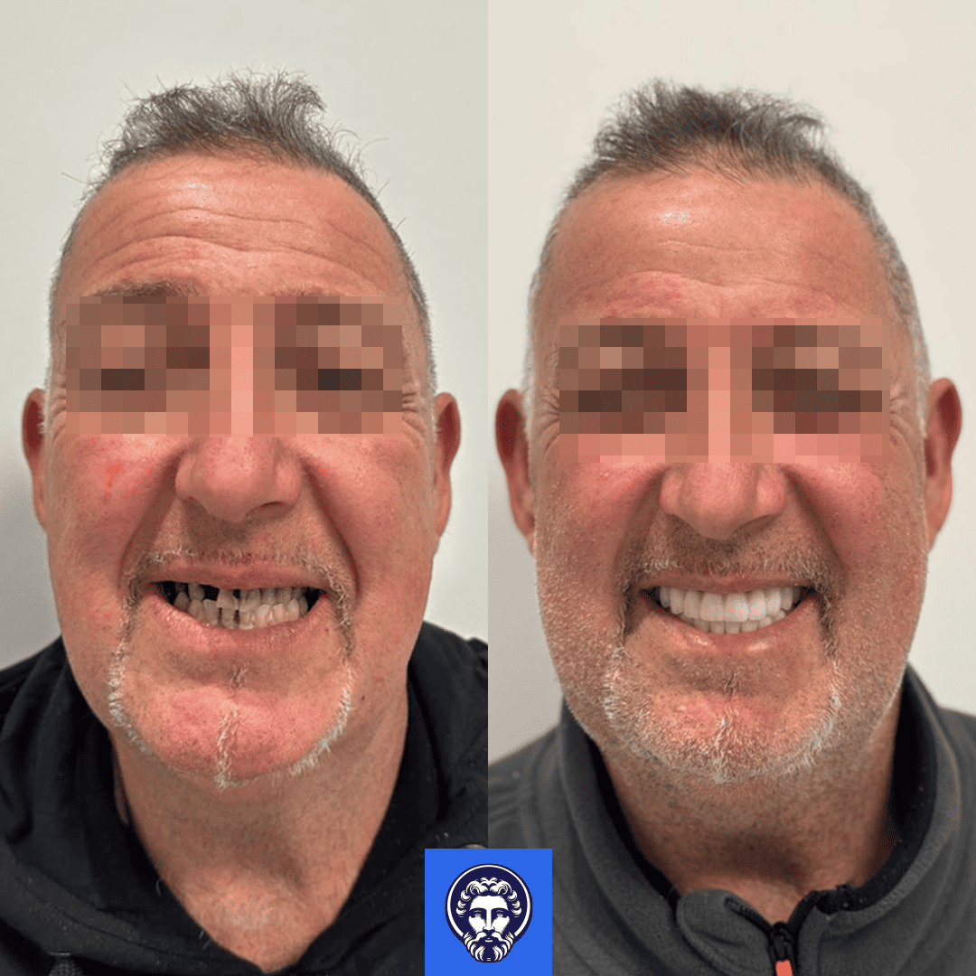 before_after