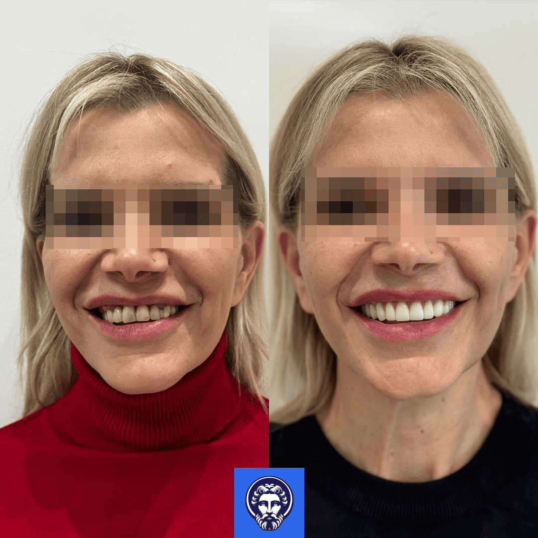 claudio before_after