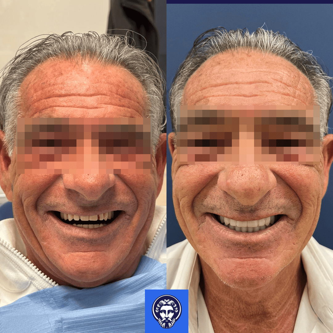 fabio tabuani before_after