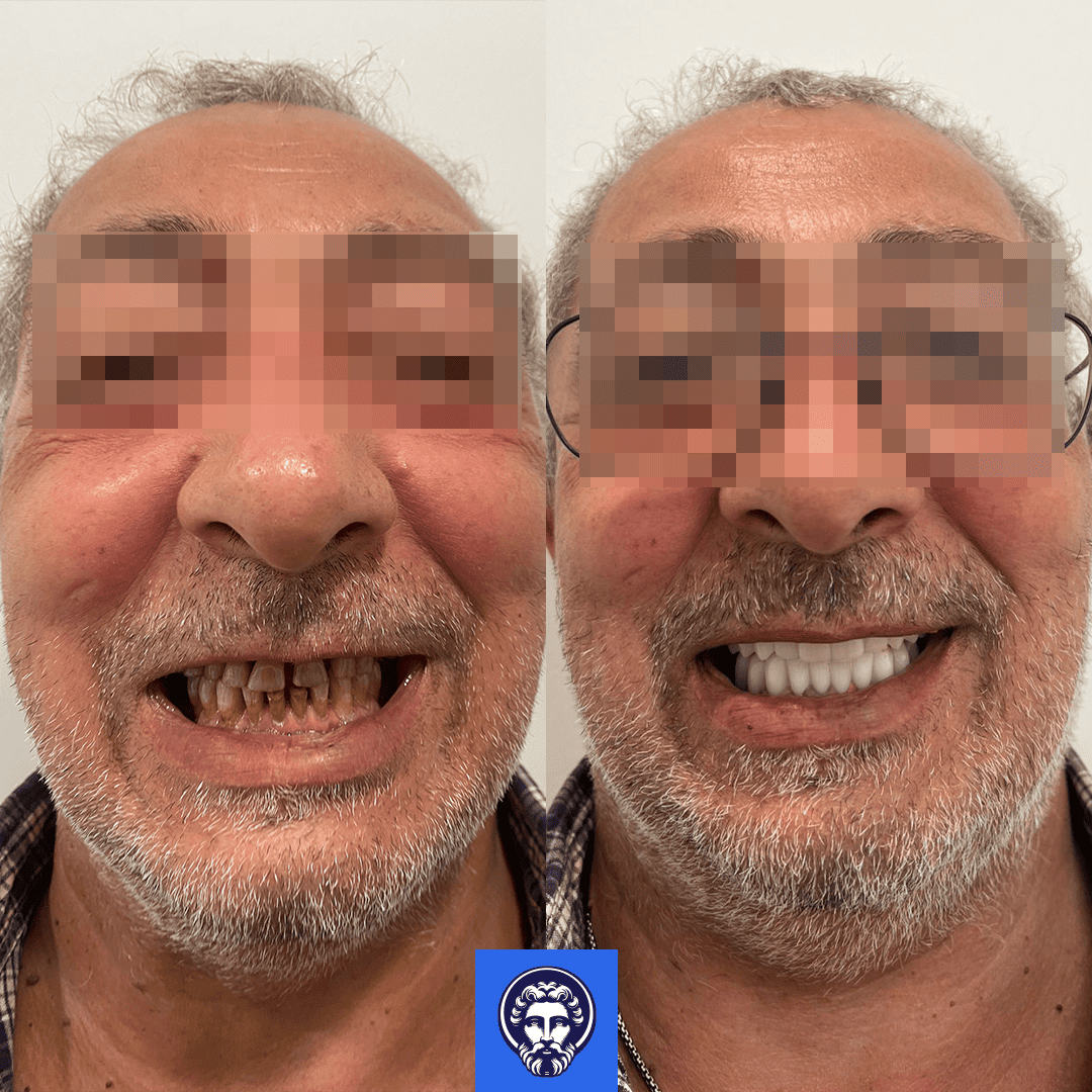 francesco filipini before_after