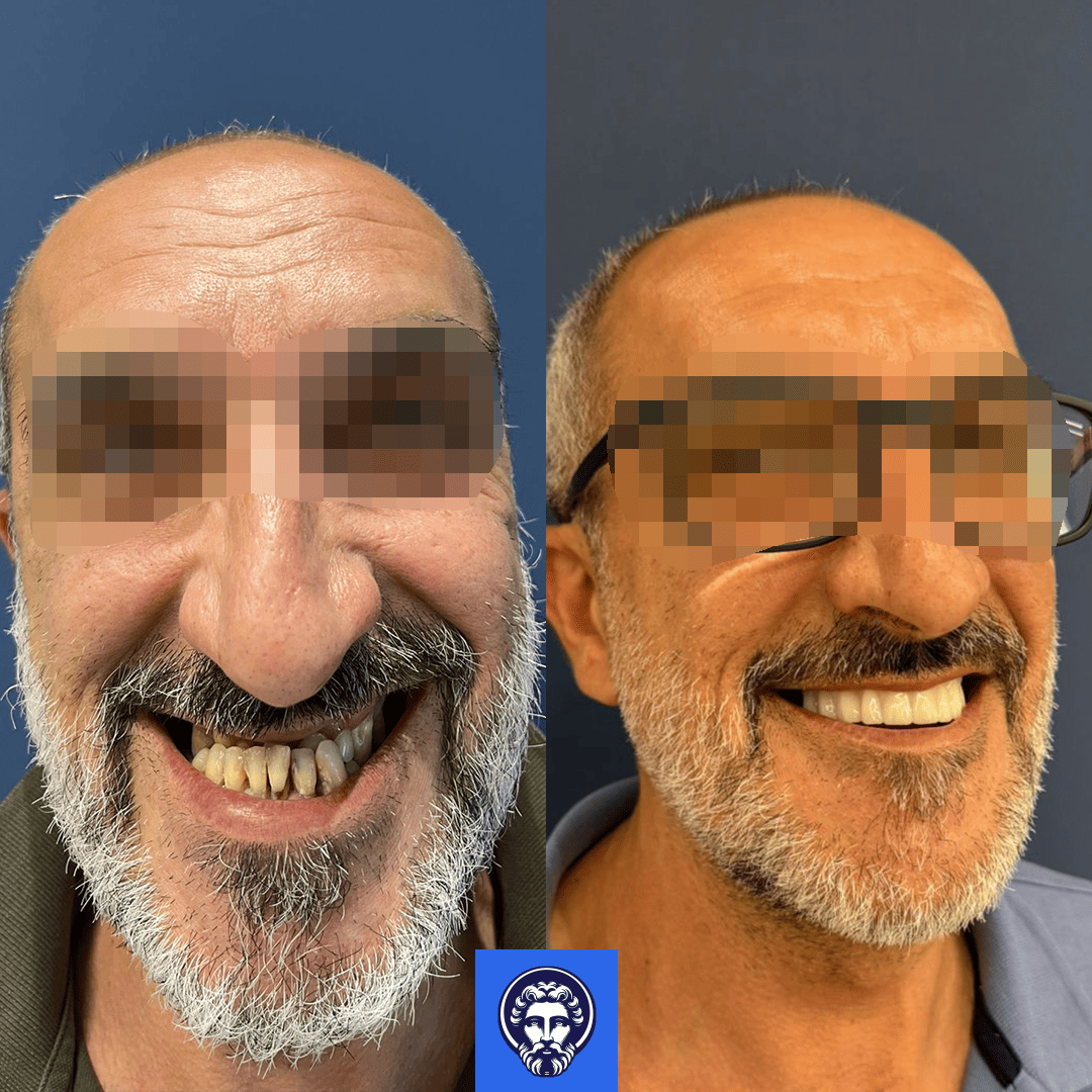 gaetano before_after