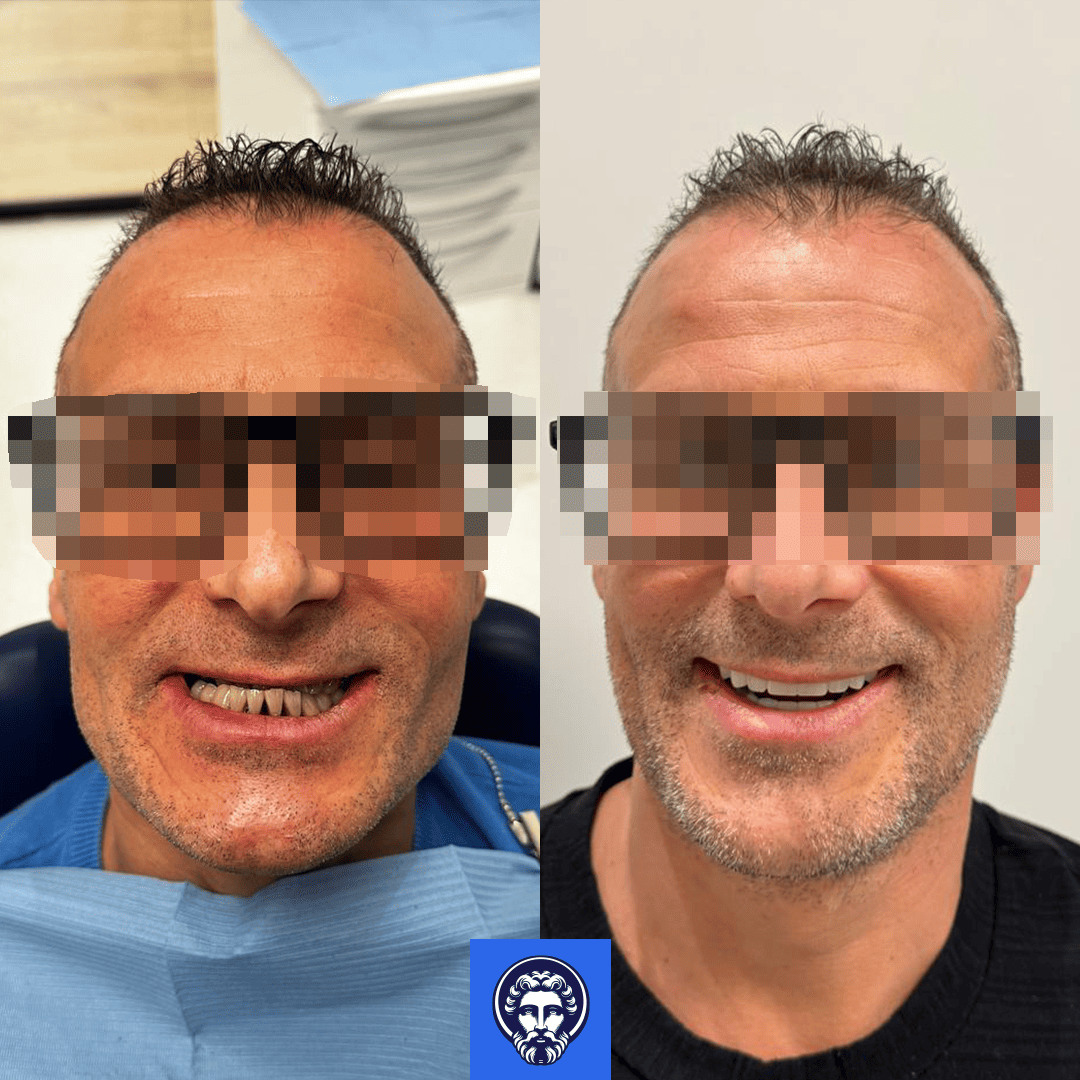 gaetano lamarca before_after