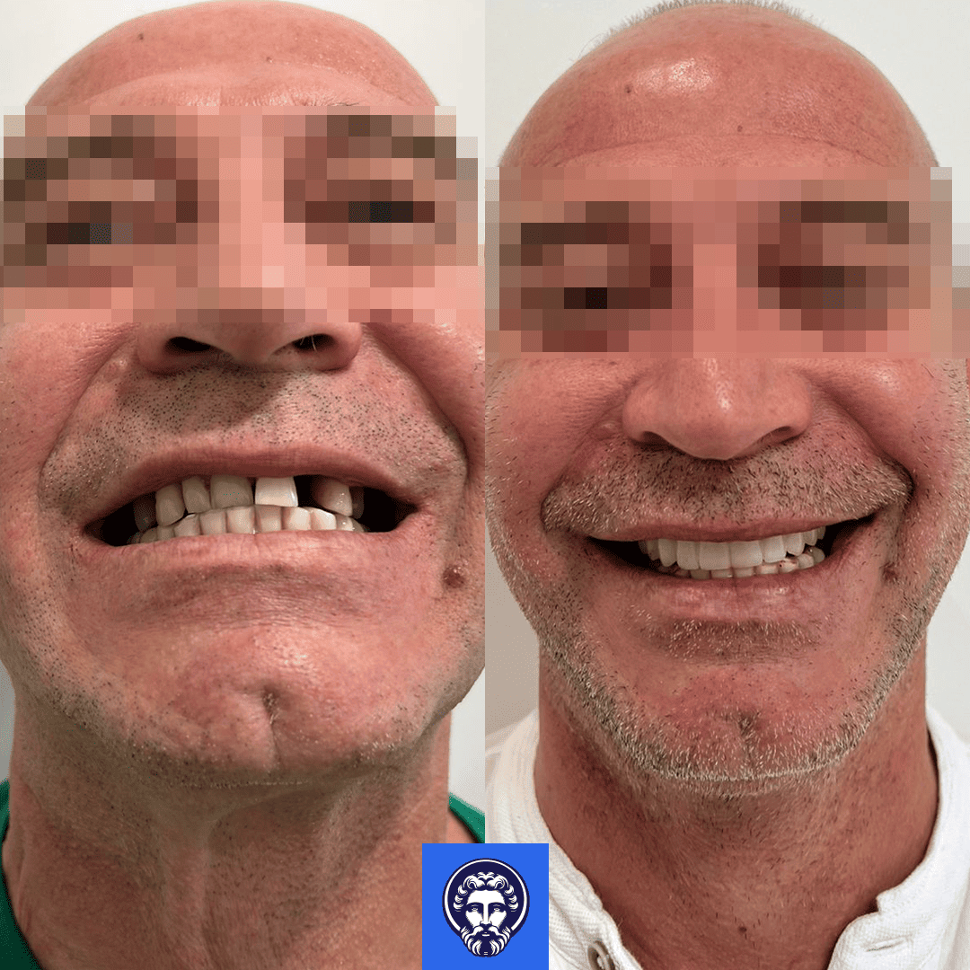 gennaro gereneo before_after
