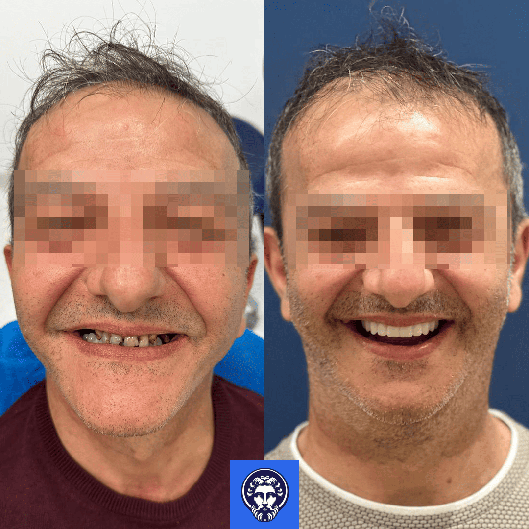 gianfelice serre before_after