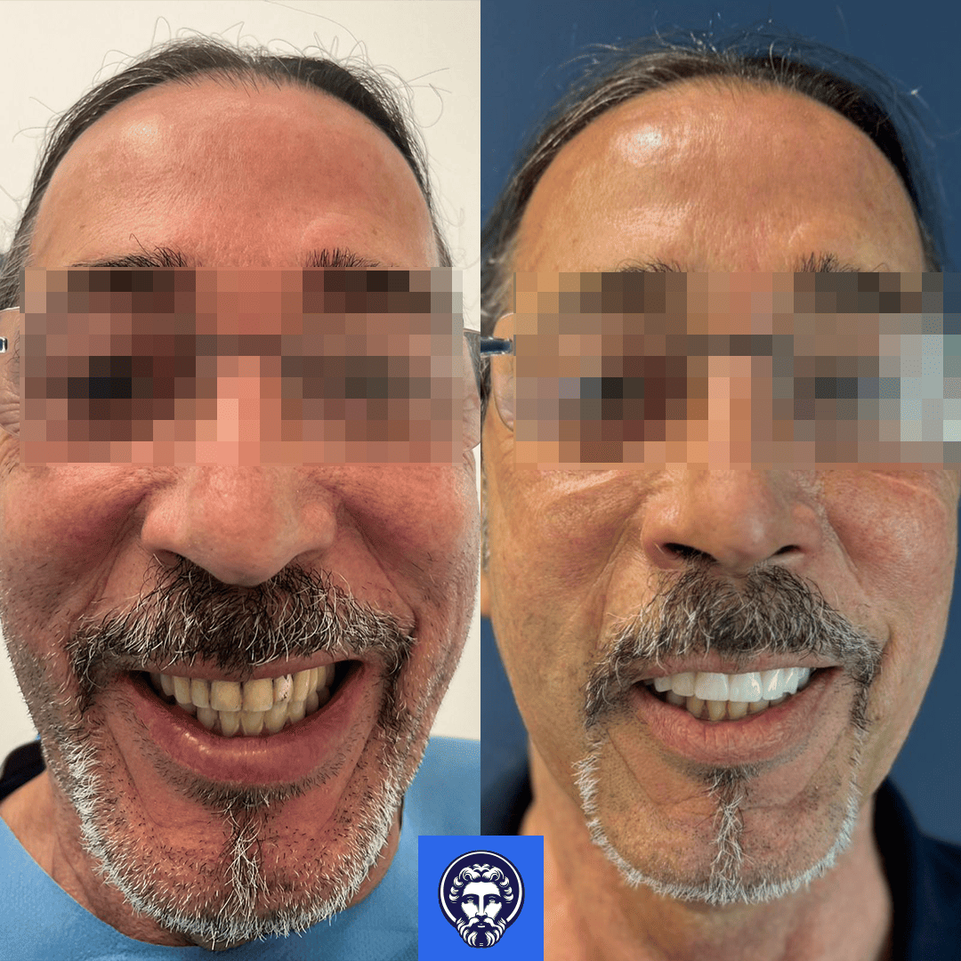 giuseppe andreacchi before_after