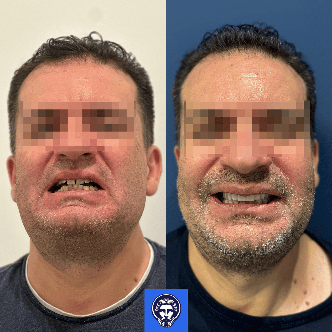 giuseppe graziano before_after