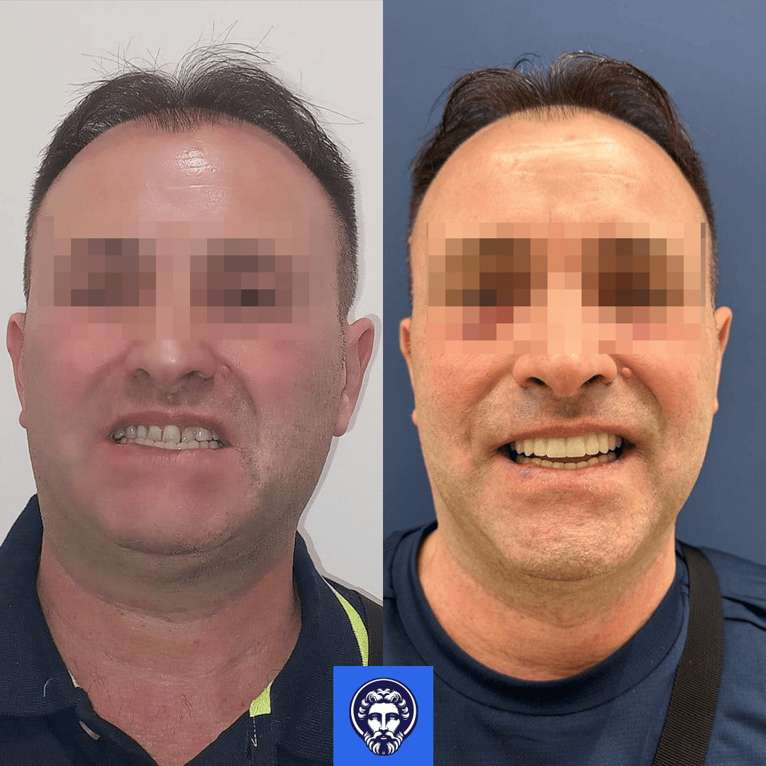giuseppe turra before_after