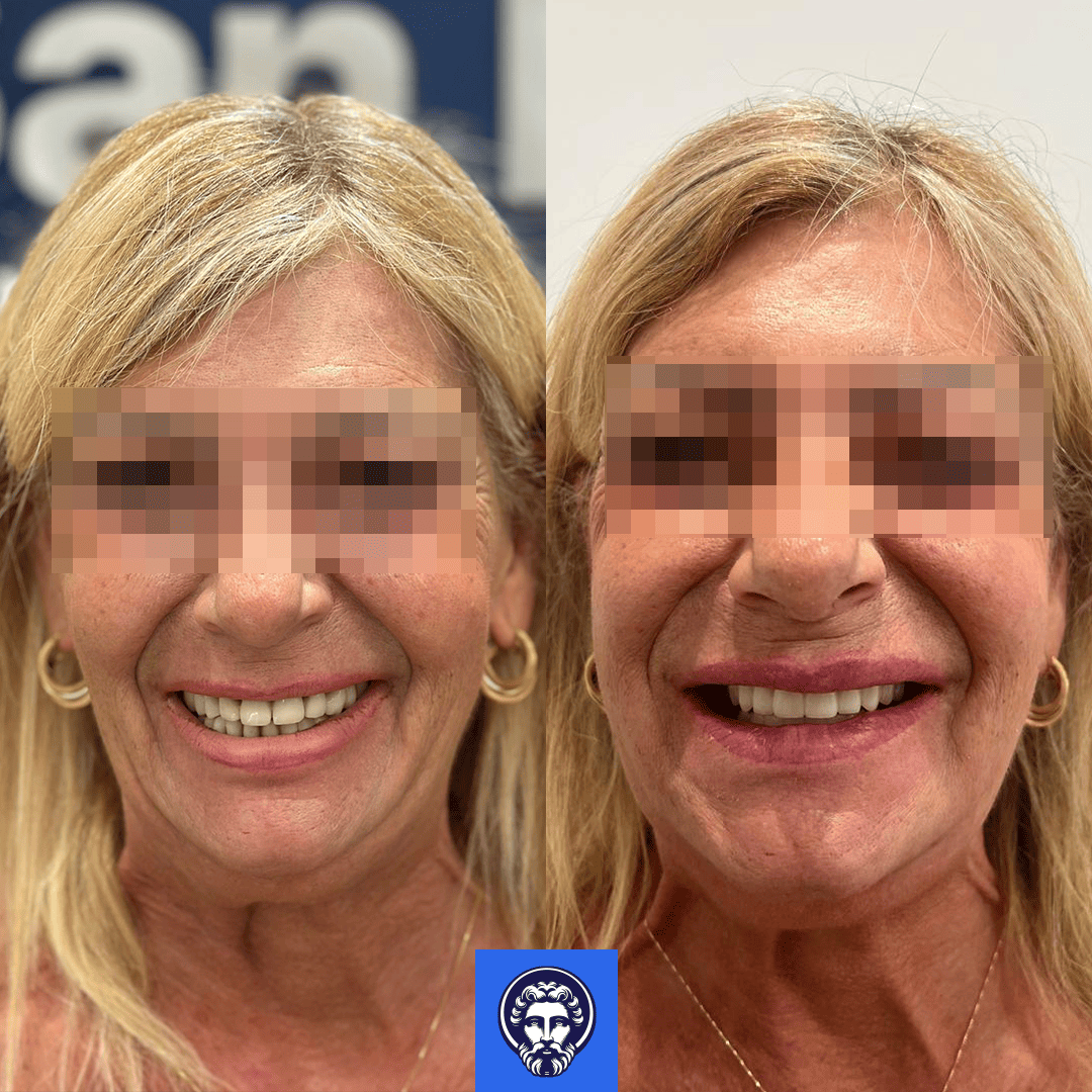 grazia zappala before_after
