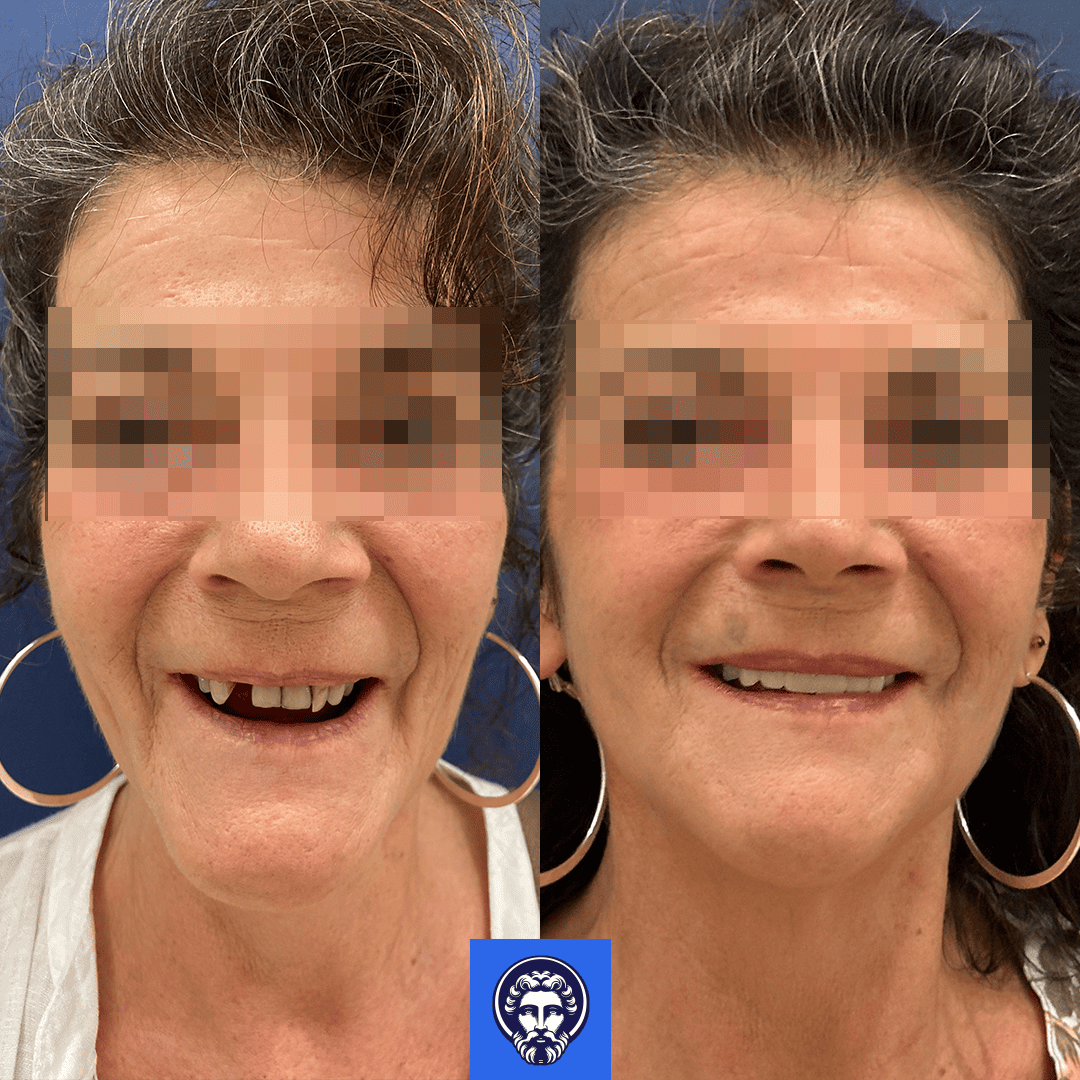 ivana merlino before_after