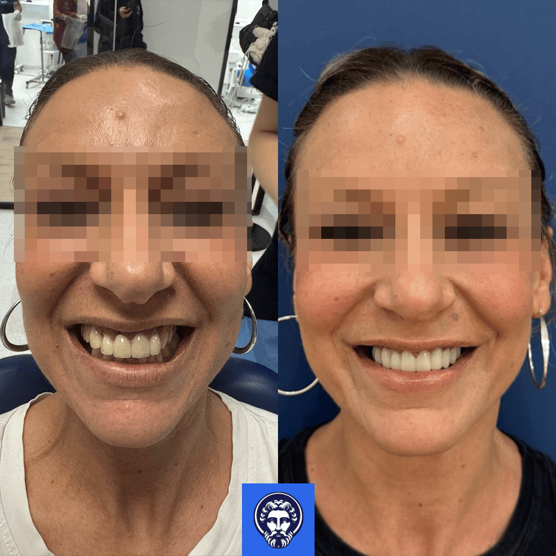 lella before_after