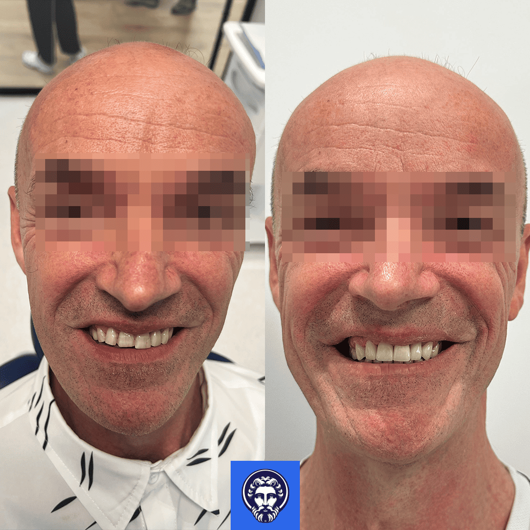 marino before_after