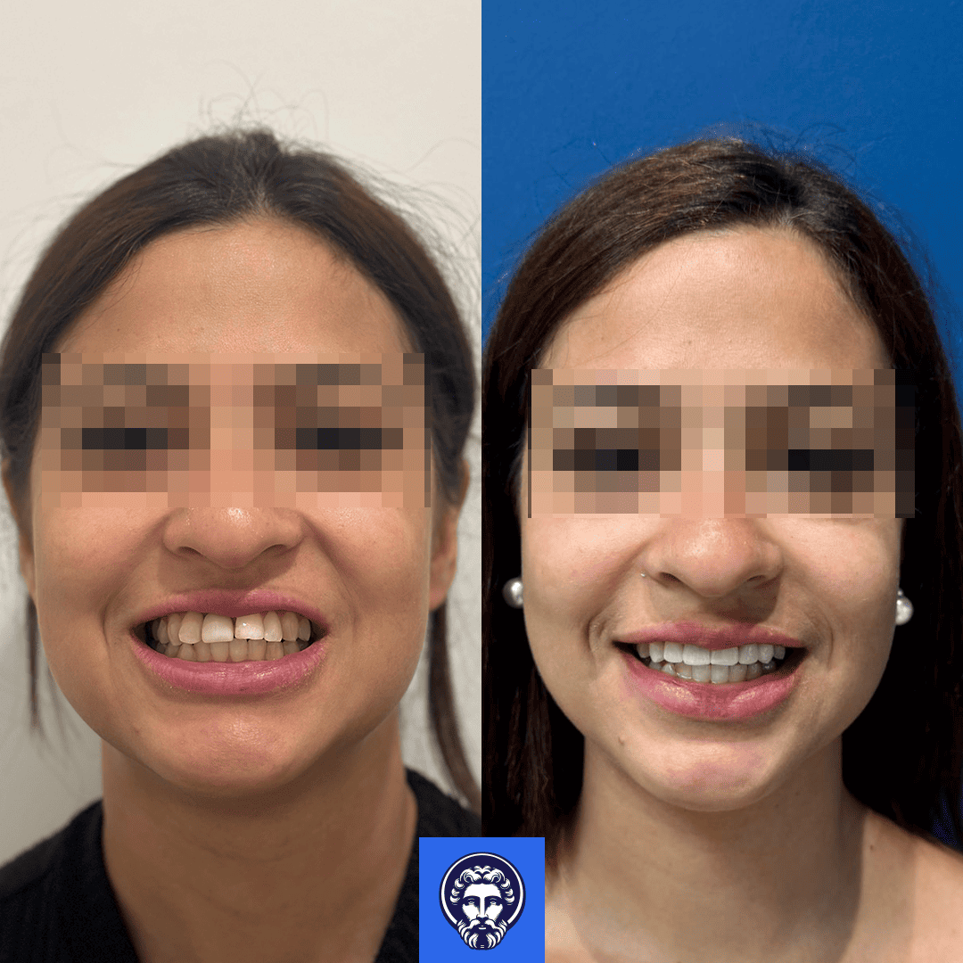 melisa greike before_after