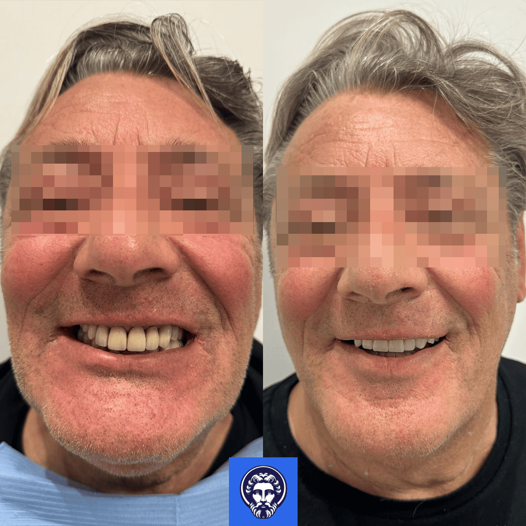 morlando before_after