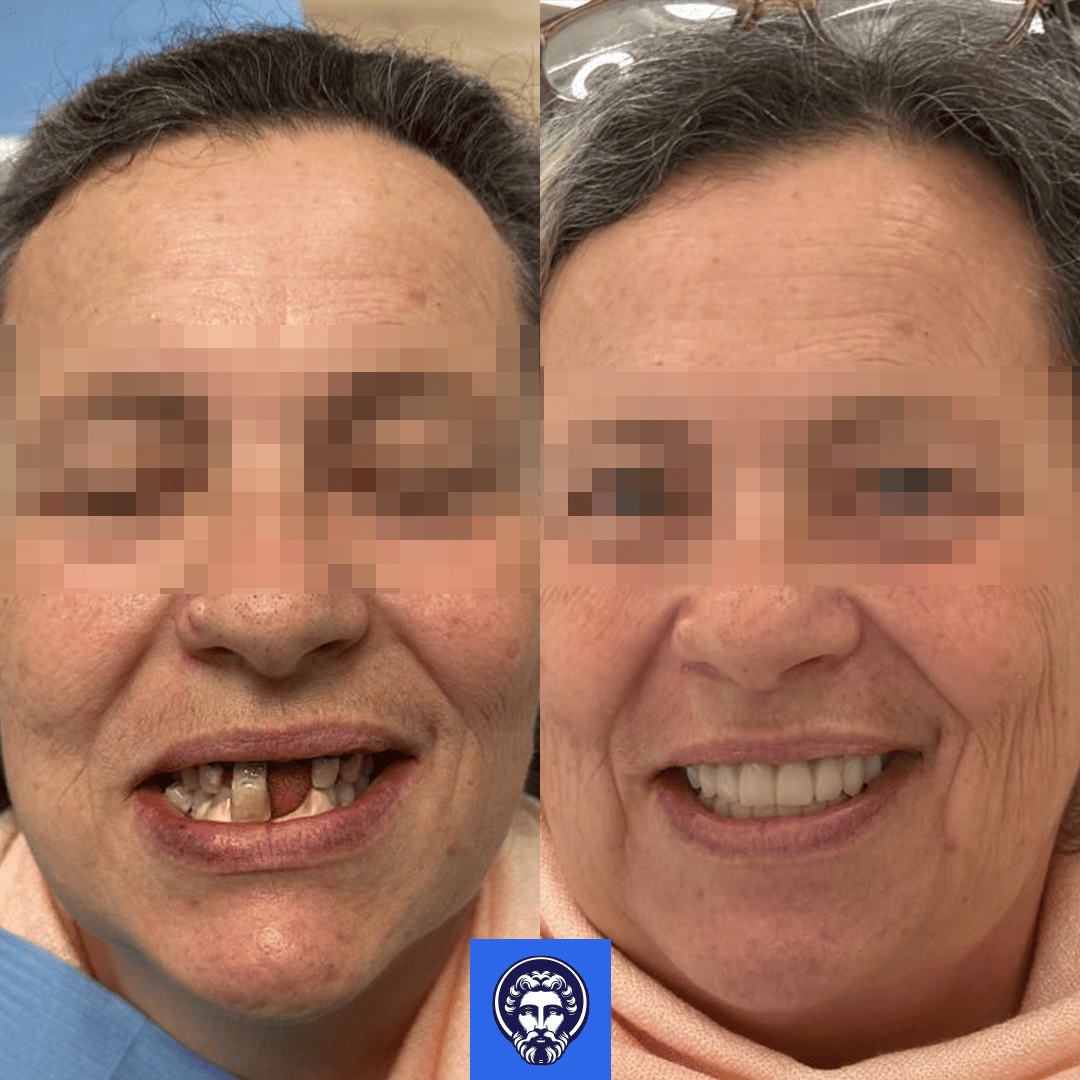patrizia before_after