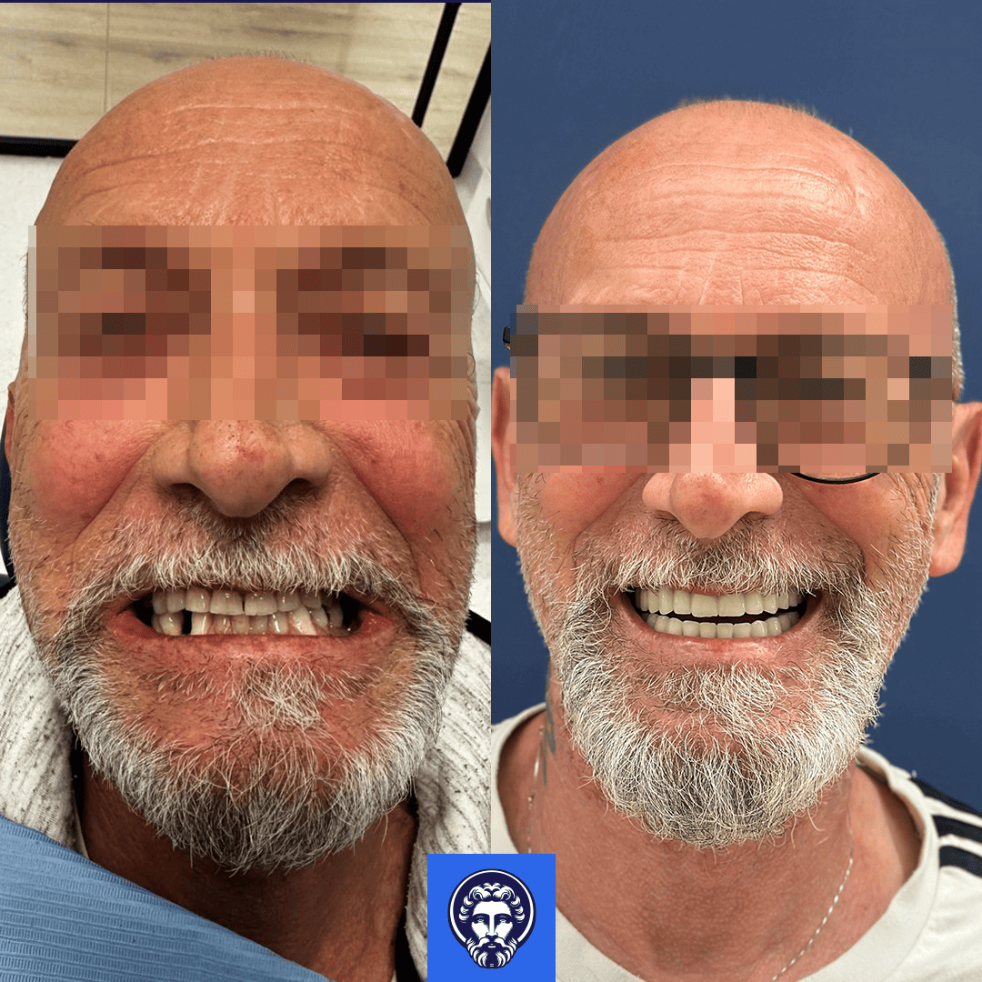 piero gili before_after