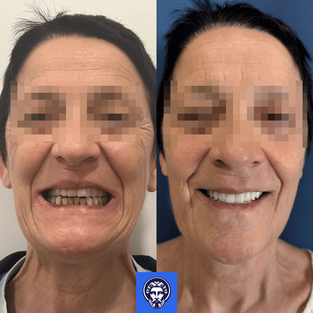 racheke mazzone before_after