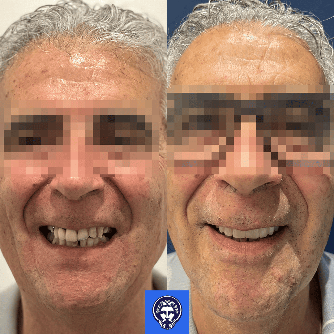 renzo before_after
