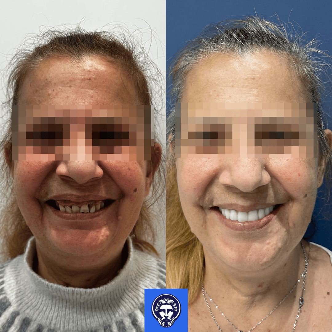 sabrina vellardi before_after