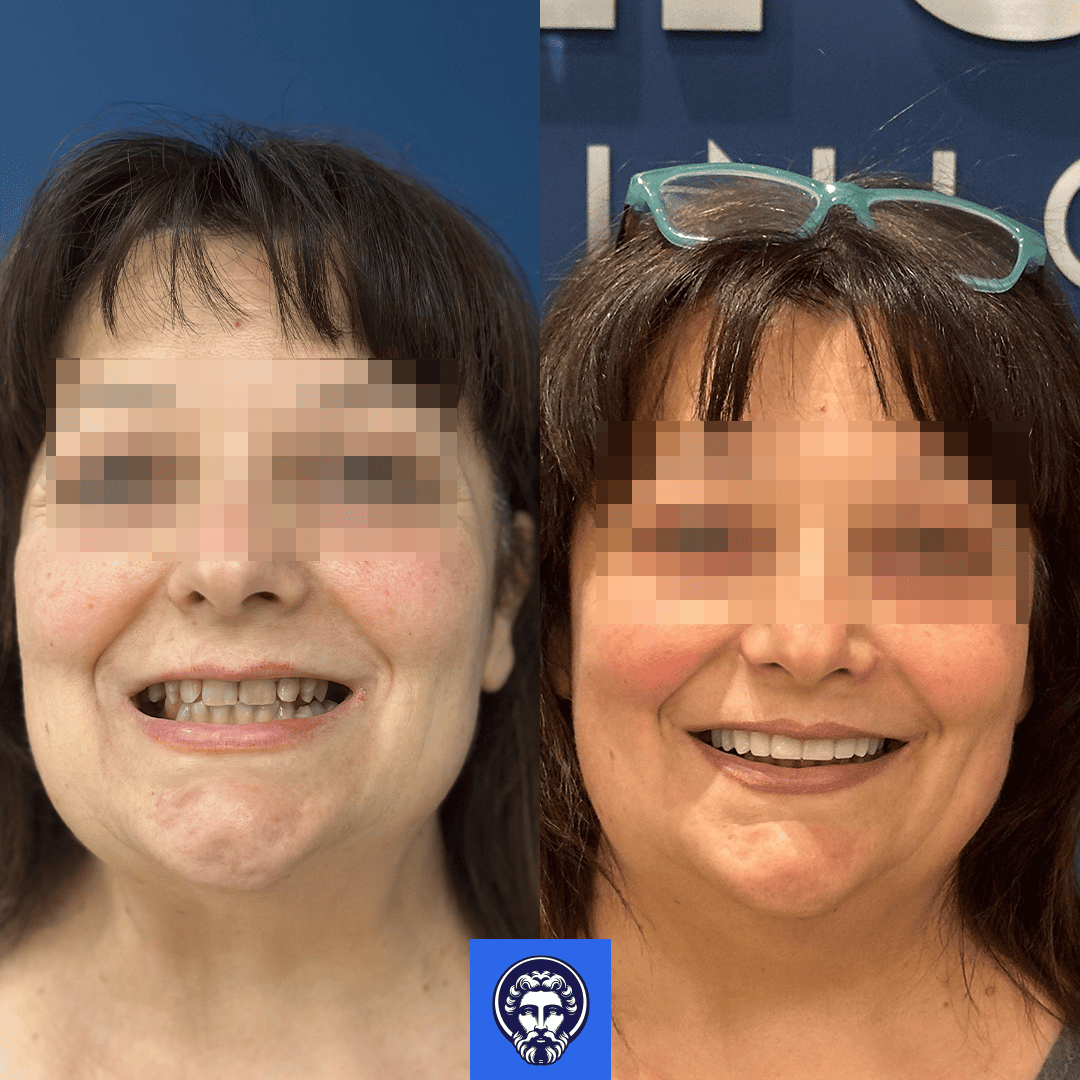 simonetta iurato before_after