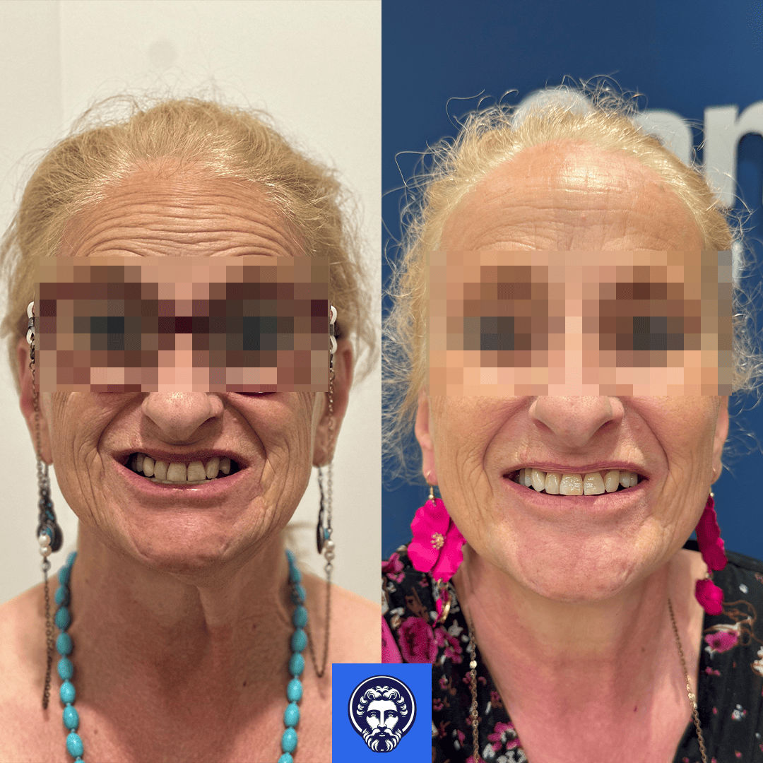 vana before_after