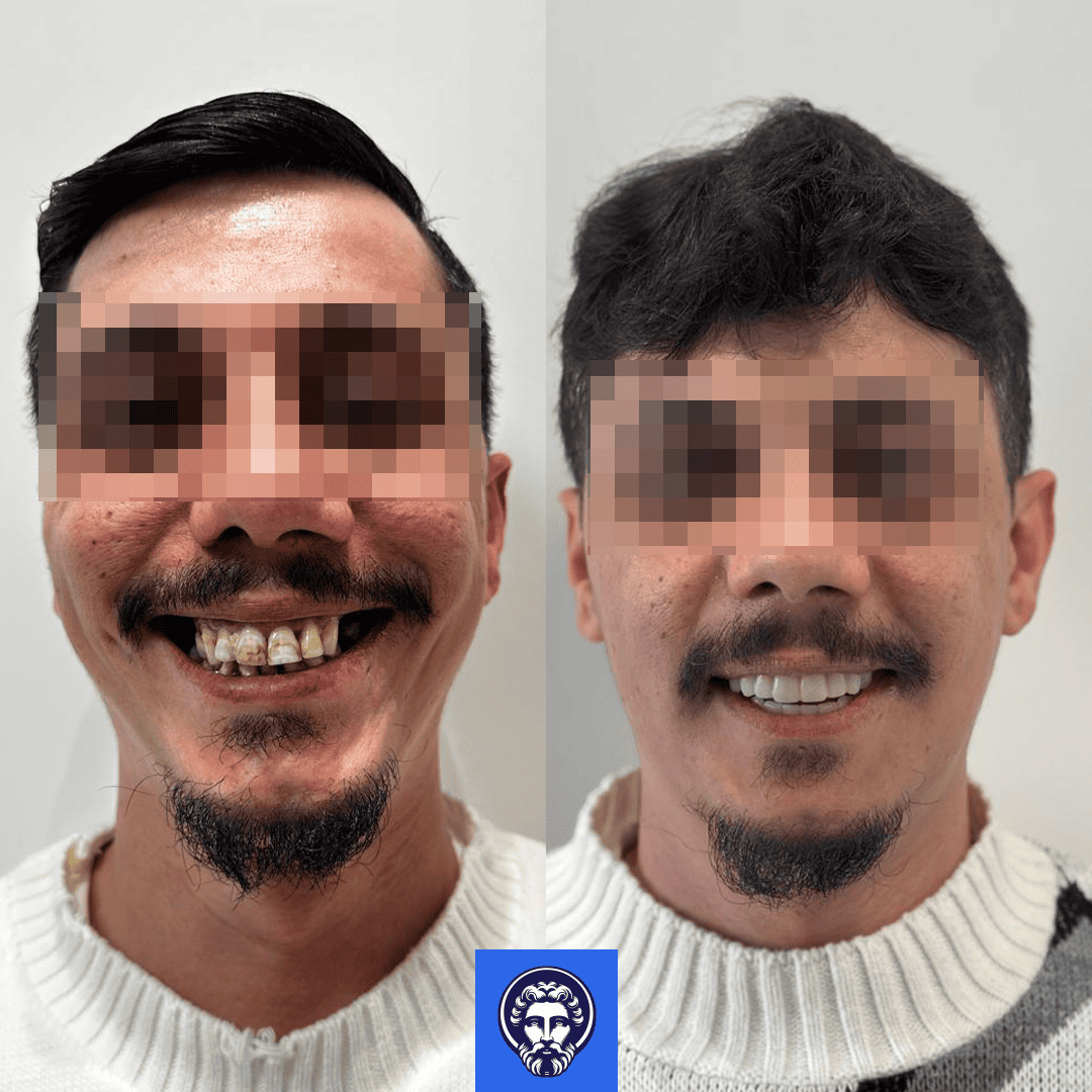 vincenzo before_after