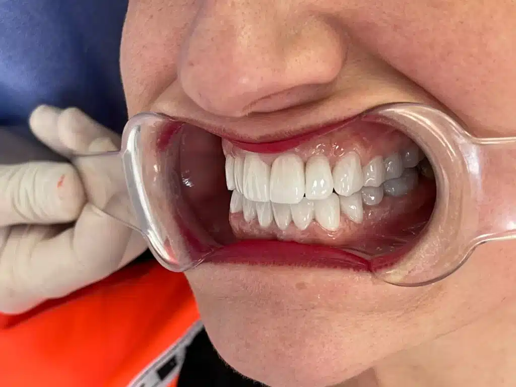 Corone in zirconia: come appaiono e perché sembrano naturali trattamento dentale