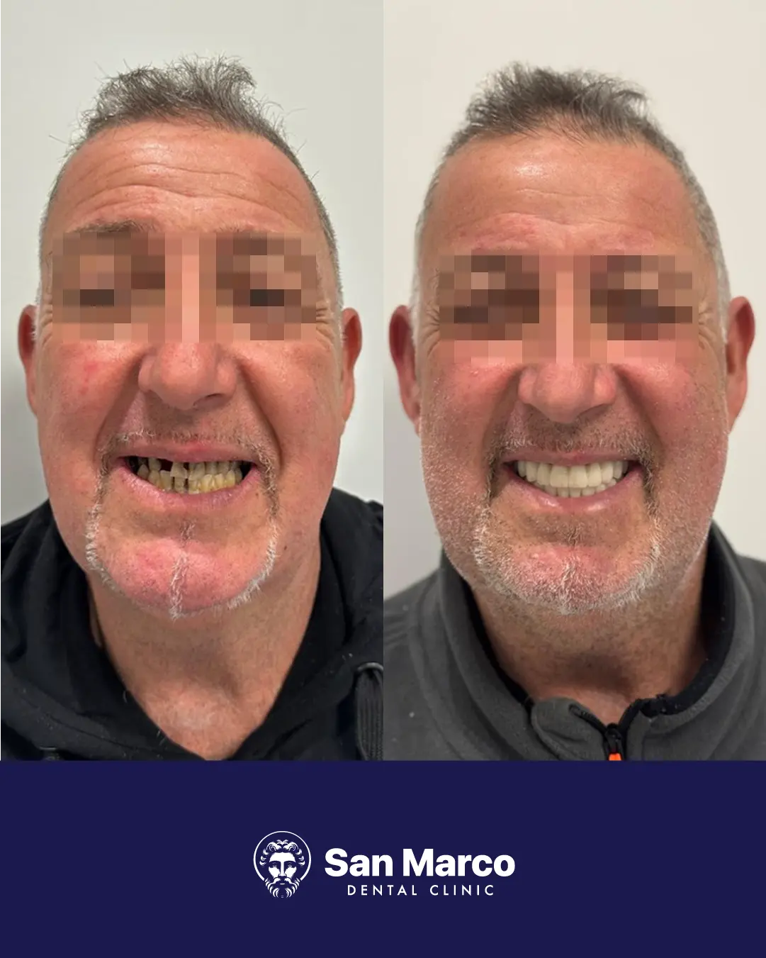 Paziente italiano San Marco Dental