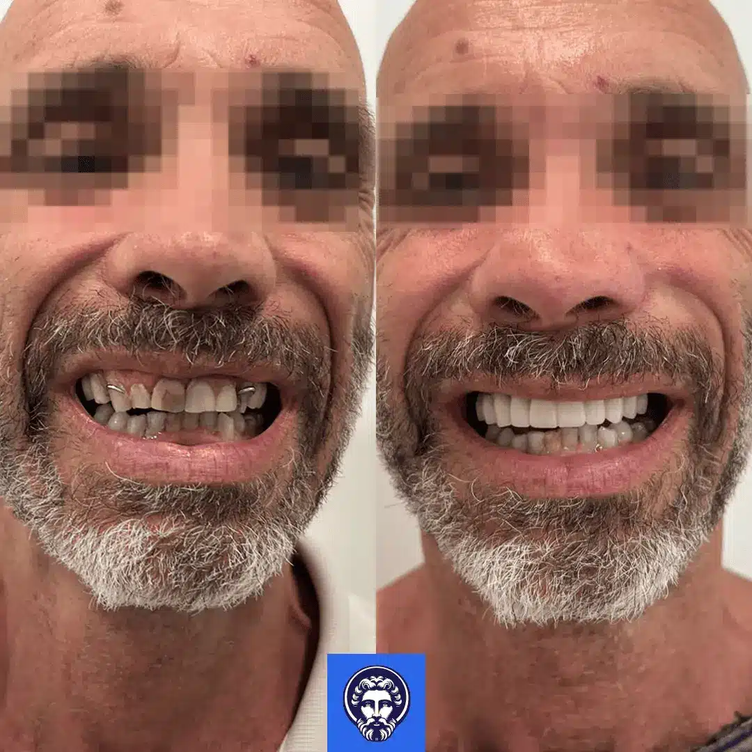 risultati impianti dentali prima e dopo albania