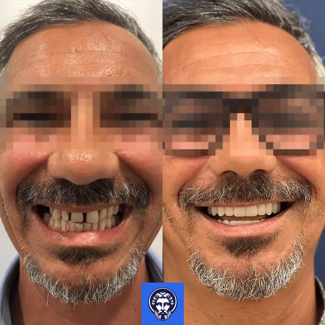 impianti dentali prima e dopo albania