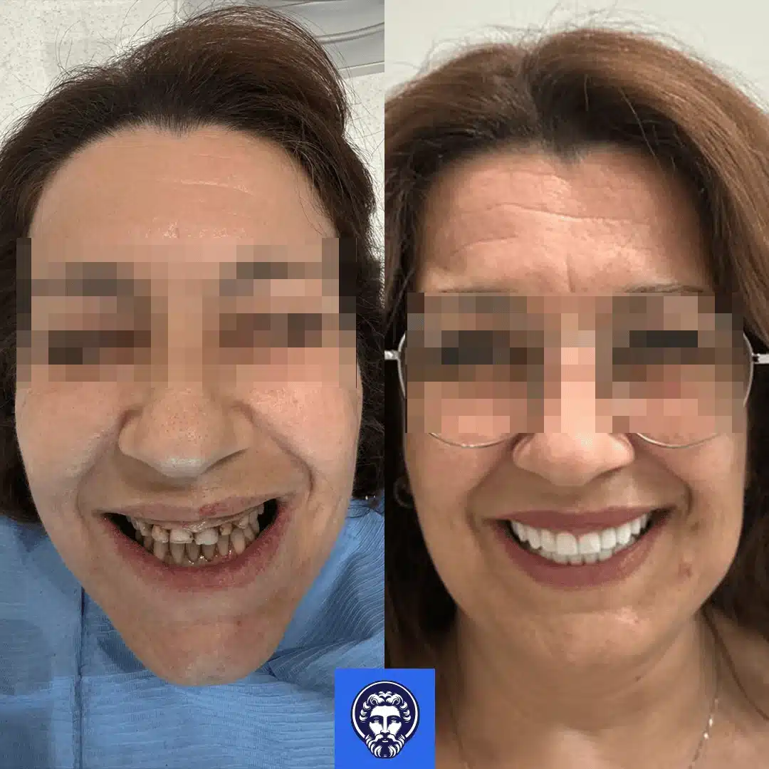 risultati impianti dentali prima e dopo albania 3