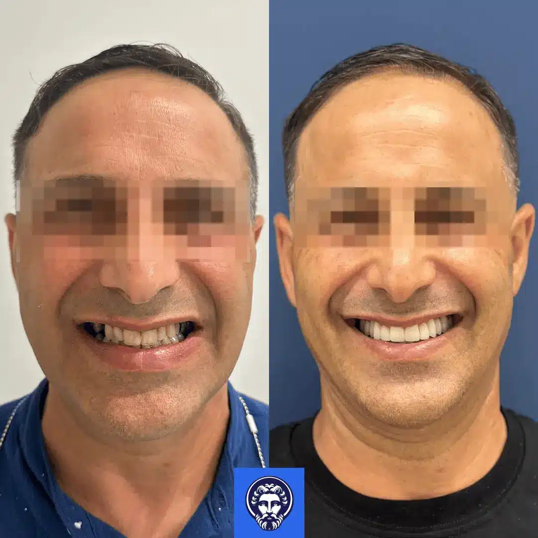 risultati impianti dentali prima e dopo albania 4